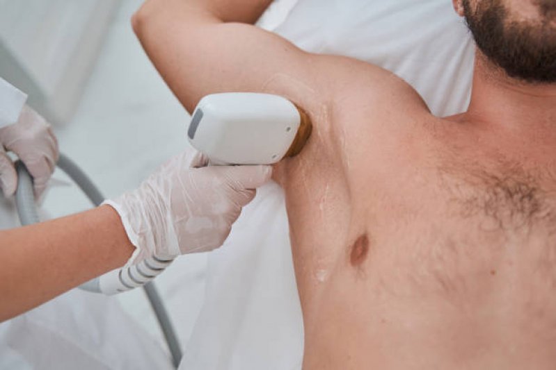 Depila&ccedil;&atilde;o a laser masculino em axila